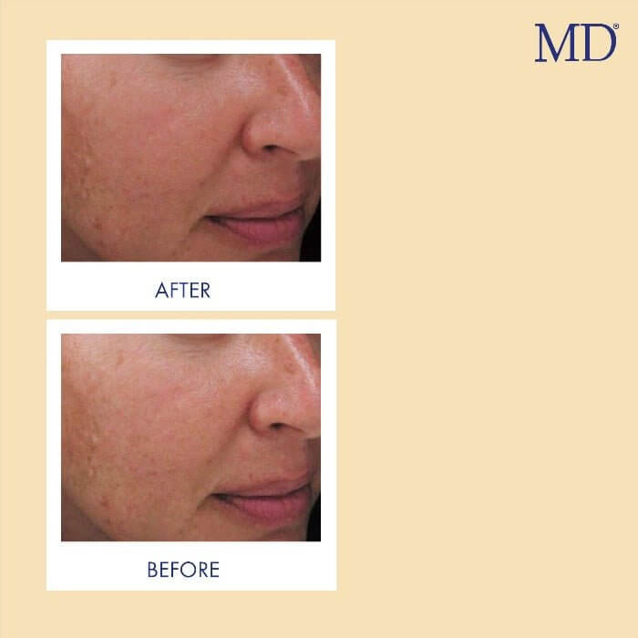 MD Factor Vitamin C Face Serum - Anti-Aging Face Serum with Vitamin C - 1 fl oz e/ 30ml - MD