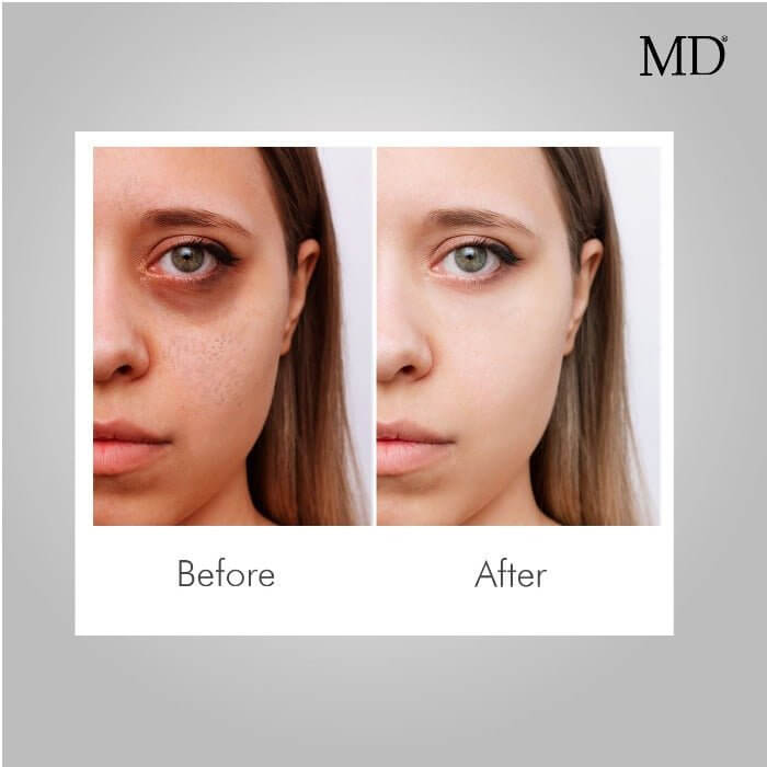 Before and after showing reduced dark circles, large pores, and hyperpigmentation, brighter, younger-looking skin with MD Skin