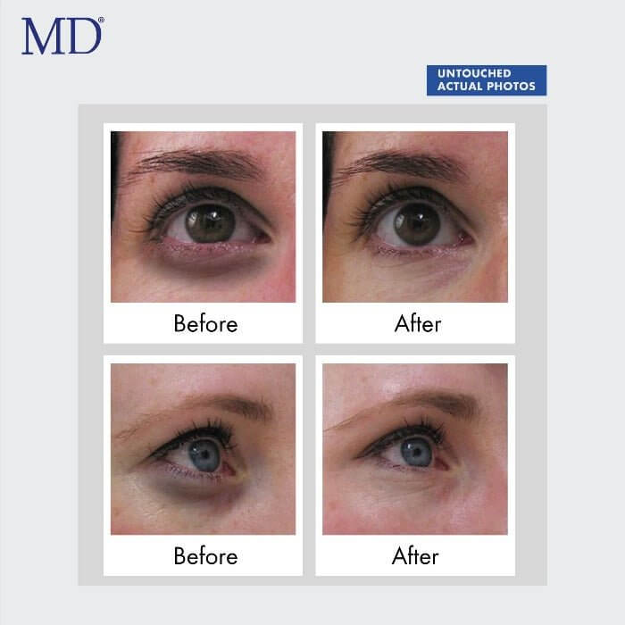 Before and after photo showing reduced dark circles and under-eye bags with regular use of MD Ultimate Eye Cream from the MD Skin collection