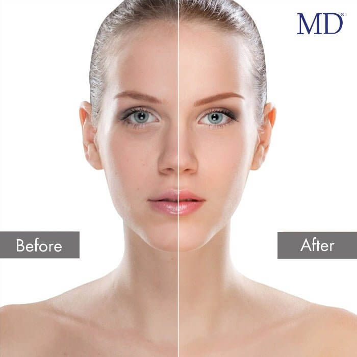 MD® Enzyme Peeling Mask for Deep Cleaning - 5 Weekly Usage Per Tube - 1 fl oz e/ 30ml - MD