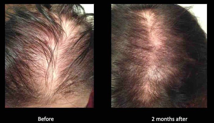 MD Nutri Hair Before and After PHotos