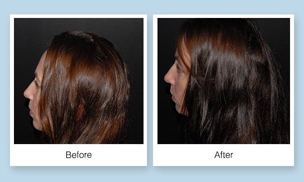 MD Hair Follicle Energizer after before