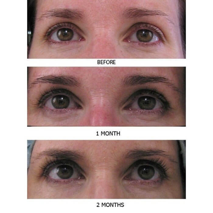 4-week and 8-week before and after photos of middle-aged woman showing dramatic improvement in lash length, fullness, and density using MD Lash Factor Eyelash Conditioner – MD Lash serum