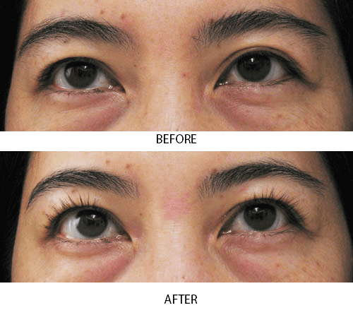 Eyelash growth transformation in ethnically diverse model after 6 weeks of MD Lash Factor – visibly curled, lengthened lashes using lash conditioner by MD Lash