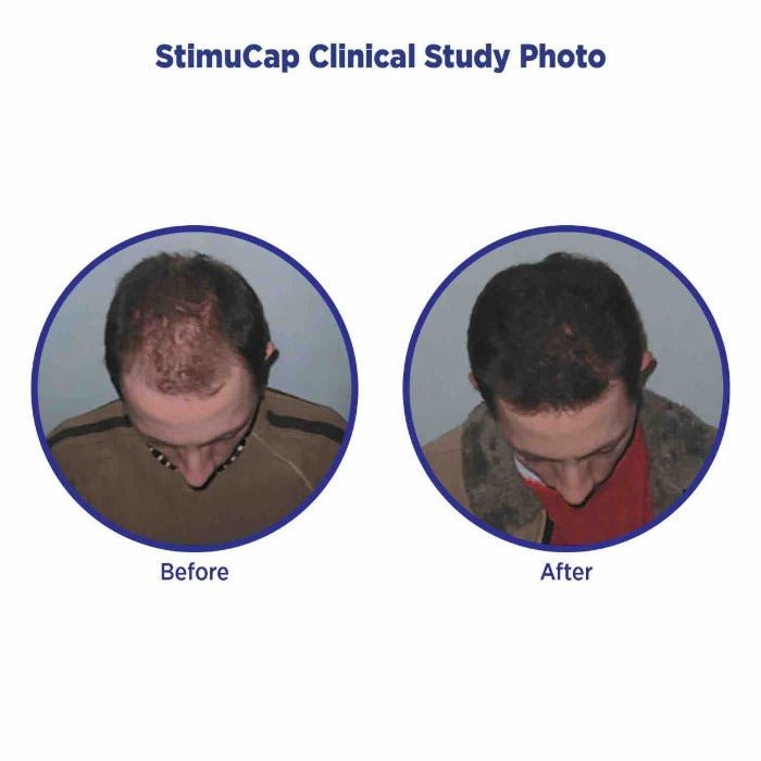 stimucap clinical study photo
